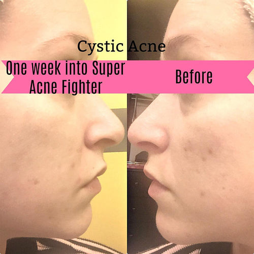 Trattamento acne organico Sajishop Super Acne Fighter con ingredienti naturali per combattere l'acne e le imperfezioni della pelle