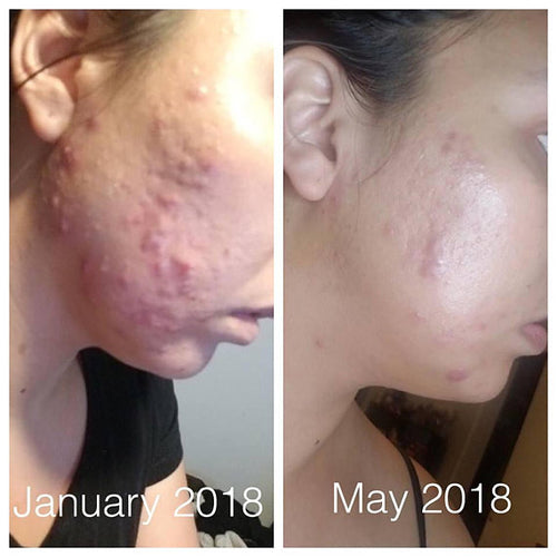 Trattamento naturale Super Acne Fighter di Sajishop per combattere l'acne, con ingredienti organici e formula efficace.